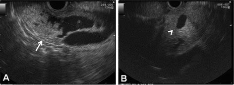 Endoscopic Ultrasonography Endoscopic Ultrasonography Demonstrated A