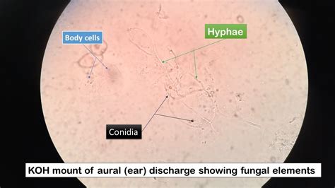 KOH Mount Of Aural Discharge With Fungal Elements Hyphae And Conidia