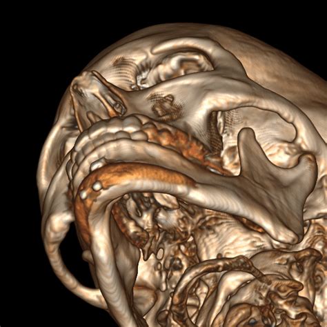 Chin Implant Overlay Of Sliding Genioplasty 3D CT Scan Left Inferior