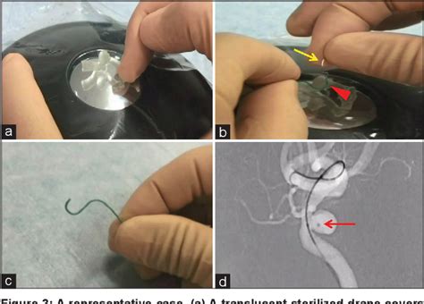 Figure From A Novel Technique Of Microcatheter Shaping Using Real