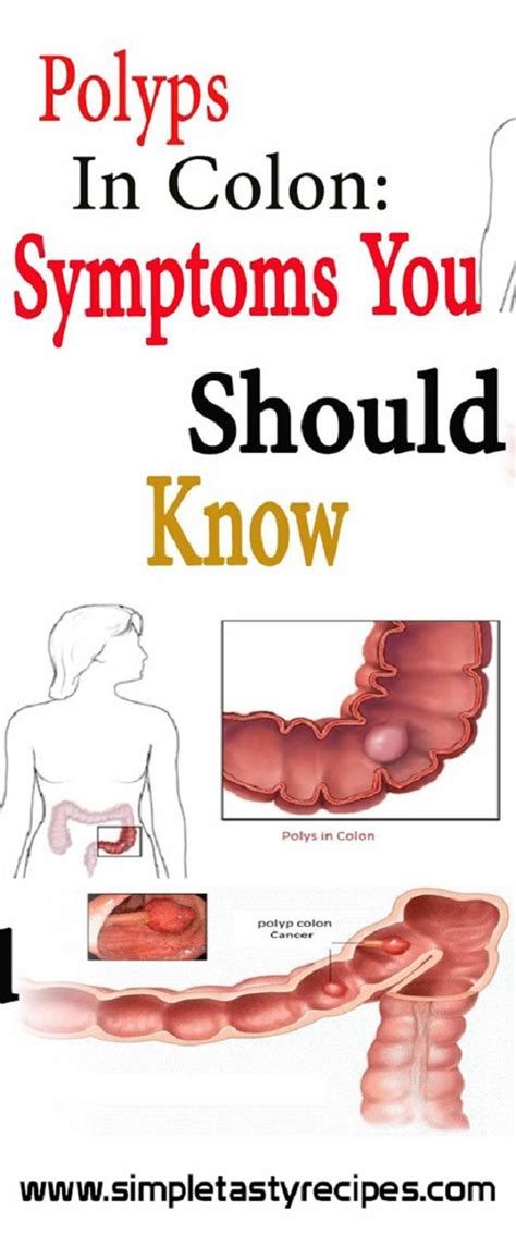 Colon Polyps Symptoms You Should Never Ignore Polyps Symptoms Polyp