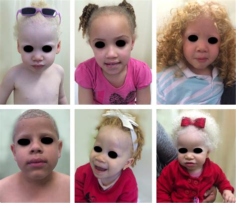 SciELO Brasil Albinism Epidemiology Genetics Cutaneous