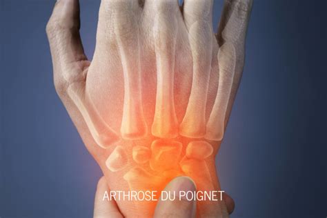 Arthrose du Poignet Docteur Duché Avignon