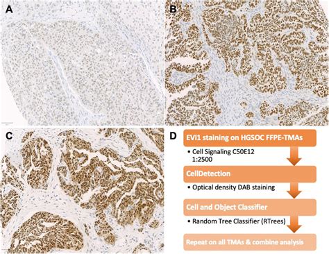 EVI1 Staining On HGSOC FFPE Tumor Tissue And Image Analysis Workflow