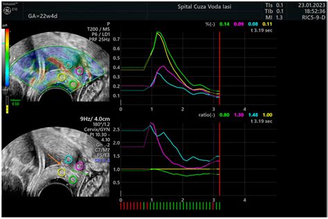 Cervical Elastography With The Dynamic Measurement Of The Strain Ratio