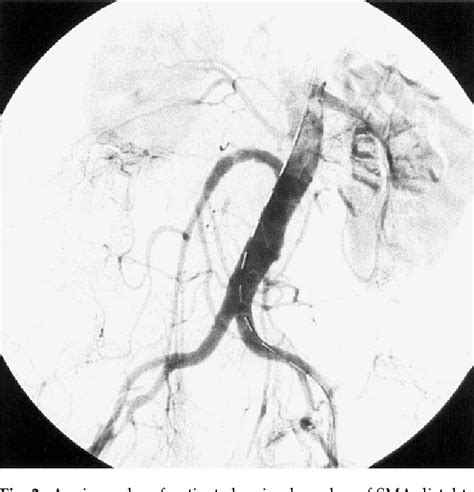 Figure 1 From A Ruptured Aneurysm Of Superior Mesenteric Artery To