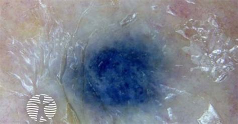 Metastatic melanoma dermoscopy image