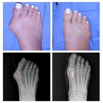 For Doctors Only Dr Moy S Painless Bunion Surgery