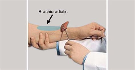 Brachioradialis Reflex