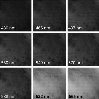 The acne skin reflectance at particular wavelengths before treatment ... 