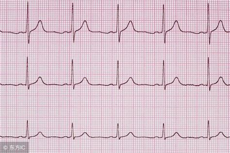 心肌梗死心電圖的定位診段 每日頭條