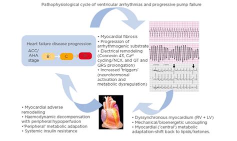 Ventricular Arrhythmias And Congestive Heart Failure EMJ Reviews