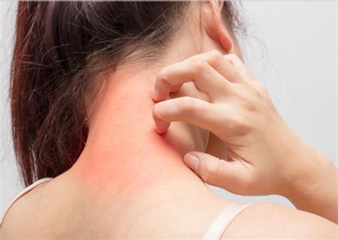 Symptoms And Cures Of A Mosquito Bite Allergy - Health Synonyms