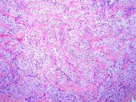 Cellular Neurothekeoma Dermatopathology