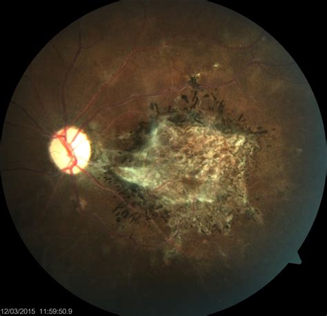 Figure Subacute Sclerosing Panencephalitis The Image