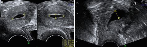 Ultrasound Evaluation Of Endometrium Obgyn Key