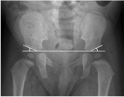 Roof Angle Acetabular - 12.300 About Roof