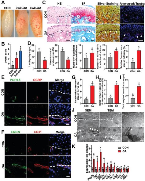 Extent Of Neurovascularization In OA A B Representative Photographs