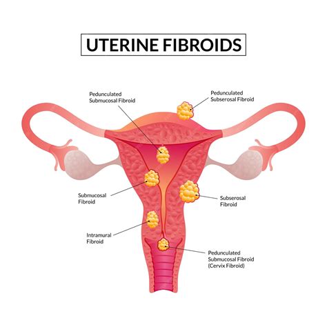 Premium Vector Types Of Uterine Fibroids Female Reproductive System