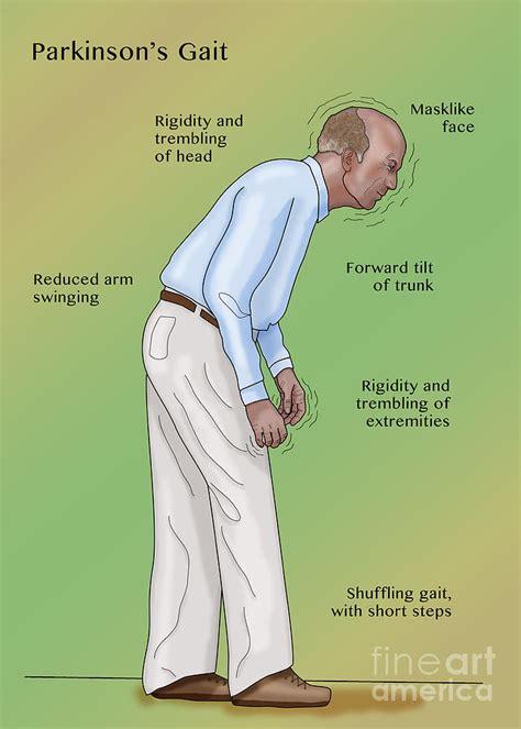 Man With Parkinsons Disease Photograph By Monica Schroeder Pixels