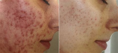 Acne Clinic Treatments Swoon Aesthetic Spa In Wexford Pa