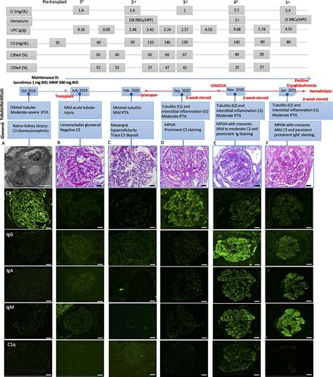 Membranoproliferative Glomerulonephritis If