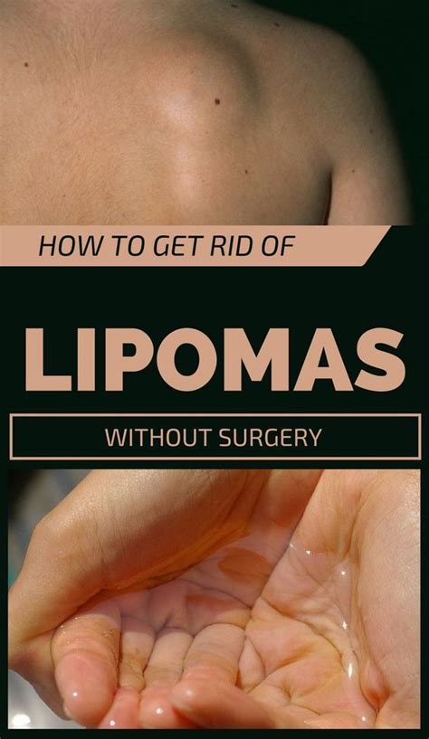 How To Get Rid Of Lipomas Without Surgery TheBeautyMania Net With