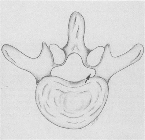 Cross-sectional view of a normal lateral recess (arrow) at the lower ...