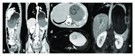 Dermoid Cyst Of The Pancreas In Ct And Mri Scans A Sagital Plane Ct