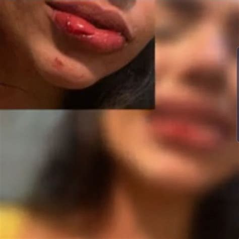 Modelo de Cuiabá acusa família de namorado por agressões em SC FOLHAMAX