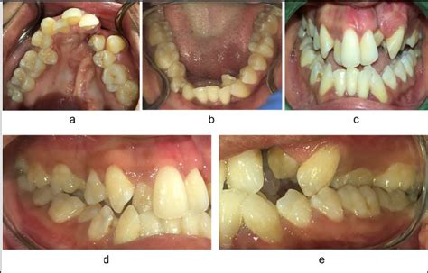 Pretreatment Intraoral Images Where A Maxillary Occlusal B