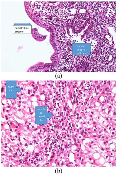 A Duodenal Biopsy Consistent With Marsh 3a—showing Partial Villous