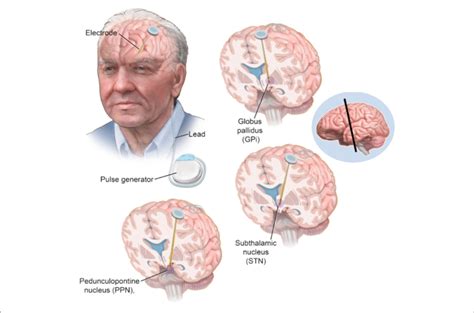 Electrode Location For Deep Brain Stimulation Approved Locations For Download Scientific