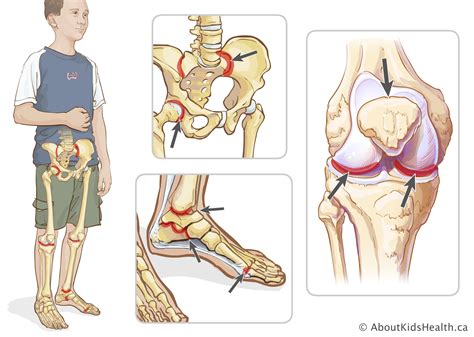 Juvenile enthesitis-related arthritis (ERA) - Arthritis WA