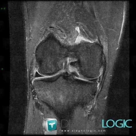 Cas Radiologie Kyste Poplit Irm Diagnologic