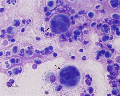 Multinucleated Giant Cell Archives EClinpath