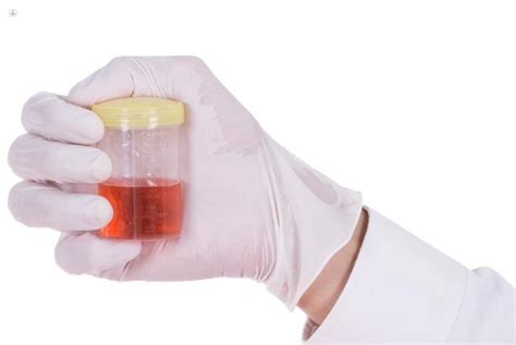 Hematuria Qu Es S Ntomas Y Tratamiento Top Doctors