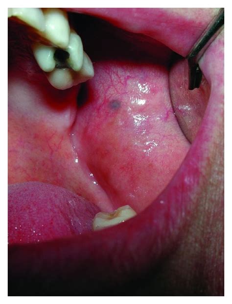 Clinical Photographs Of The 22 Mm Pigmented Lesion Of The Right Buccal