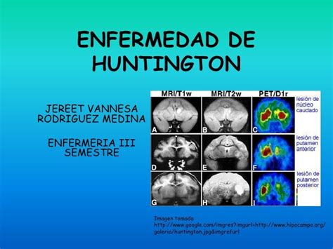 Enfermedad De Huntington