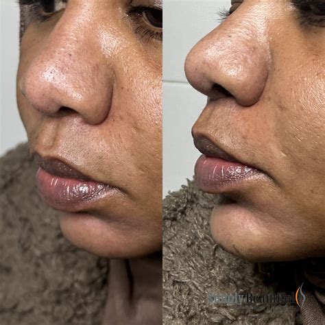 Chin Filler Injection Dr Peter Kim Surgery Skin Cancer Cosmetic