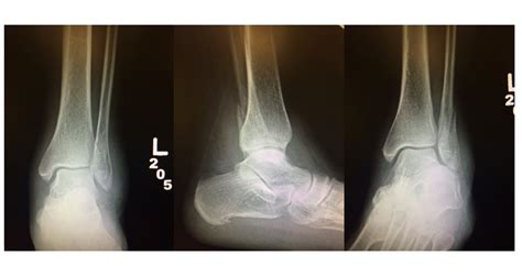 Emergency Medicine Educationcore Em Ankle Stress Views