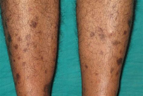 What does diabetic skin look like | Symptoms and pictures