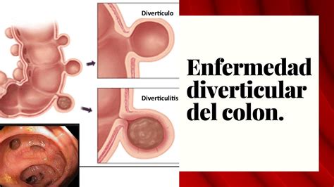 Enfermedad Diverticular Del Colon Un Momento De Salud 10 07 20 Youtube