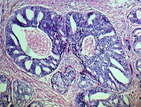 Photomicrograph Of Gleason Pattern 5 With Comedo Necrosis H E X 100