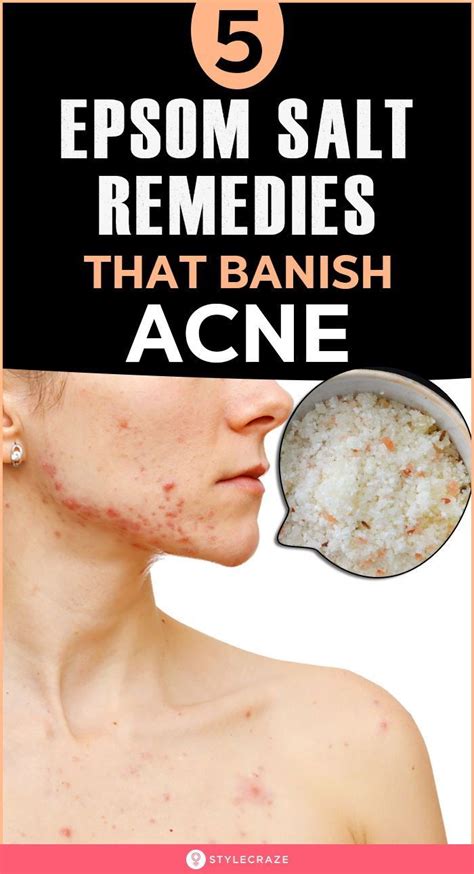 5 Epsom Salt Remedies That Banish Acne Epsom Salt Acne Remedies