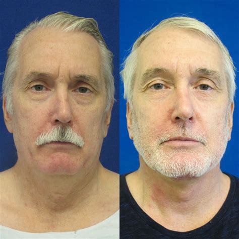 Washington DC Male Facelift Surgery Before and After Pictures | Tysons Corner