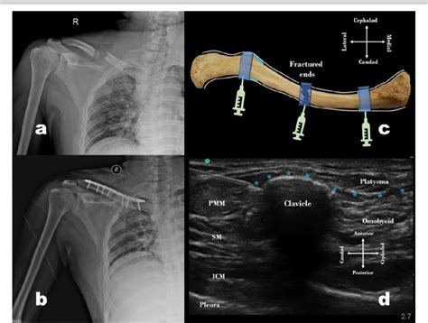 PDF Modified Clavipectoral Fascial Plane Block To The Rescue