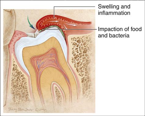 Dental Pain, Pericoronitis | Anesthesia Key