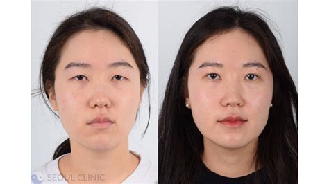 Double Eyelid Surgery Korea Costs Clinics June 2024