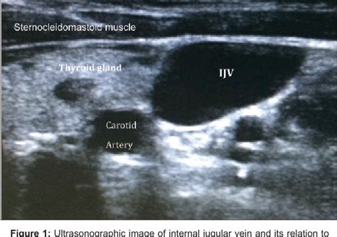 Figure 1 From Ultrasound Guided Internal Jugular Venous Cannulation Comparison With Land Mark